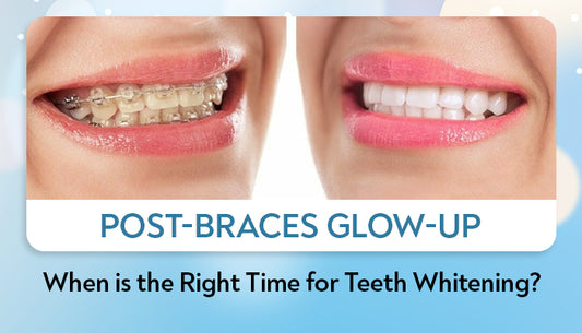 Post Braces Glow Up: When Is the Right Time for Teeth Whitening?